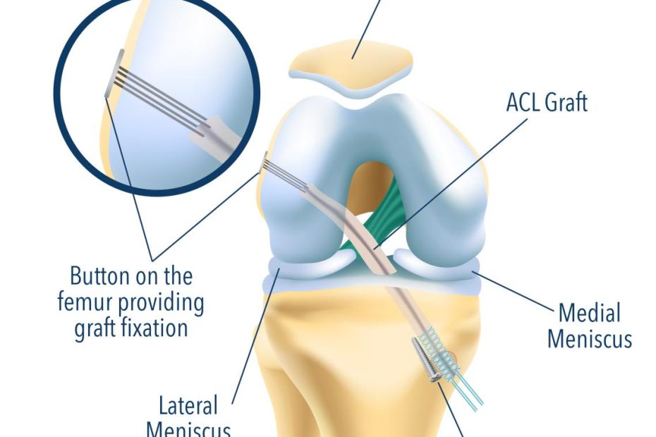 The Acl Injury Guide - A Guide For Patients About Acl Injuries And Acl  Surgery