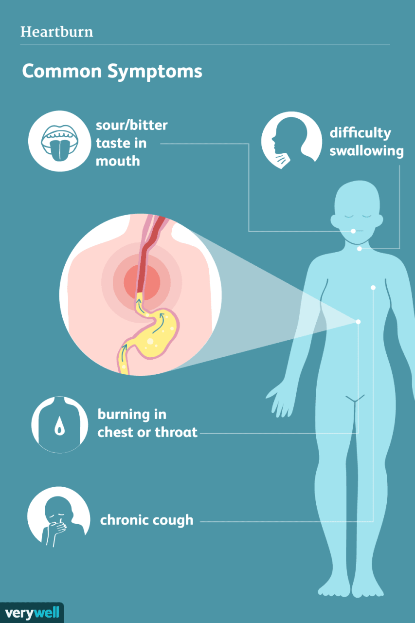 What Does Severe Heartburn Feel Like Understanding The Discomfort 